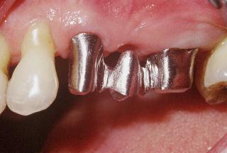 Implant2.jpg (11483 octets)